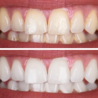 Woman's Teeth Before And After Whitening