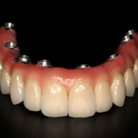 Implant_ceramica-10-700x500